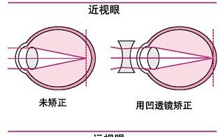什么是矫正镜片，什么是矫正度数